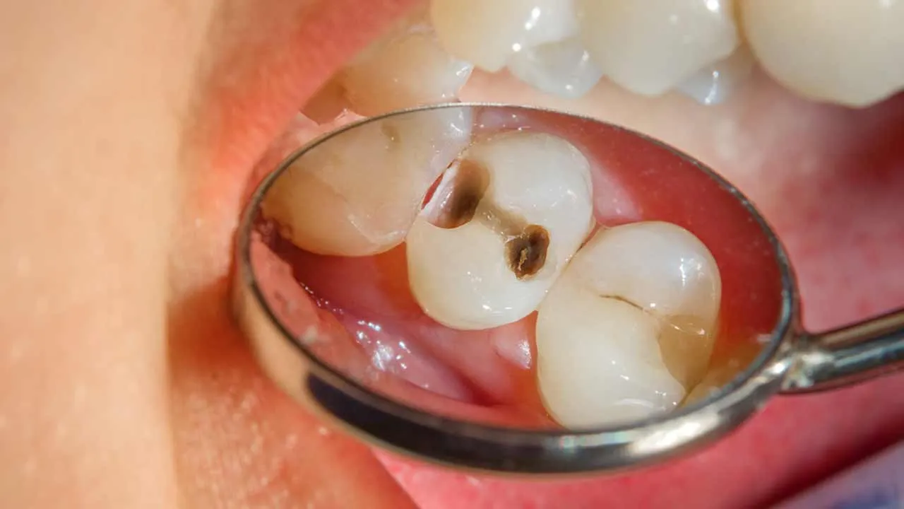 Dental Caries Treatment in Annandale, VA