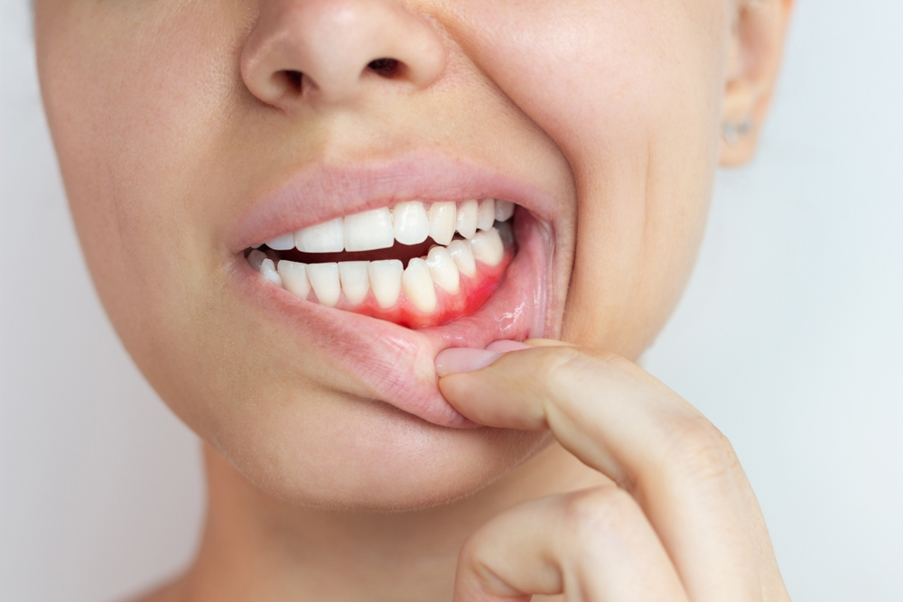 Gums