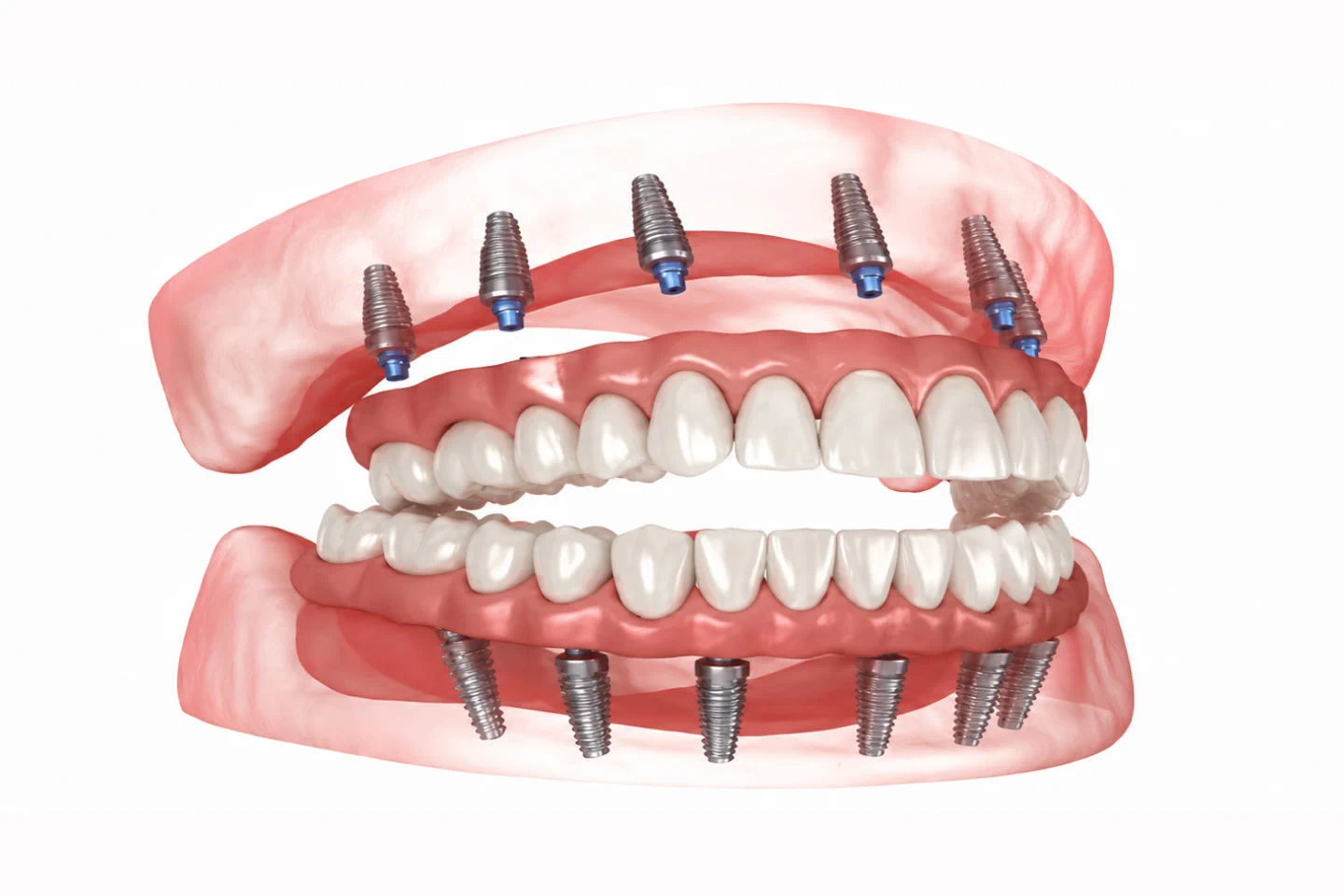 Full Mouth Reconstruction