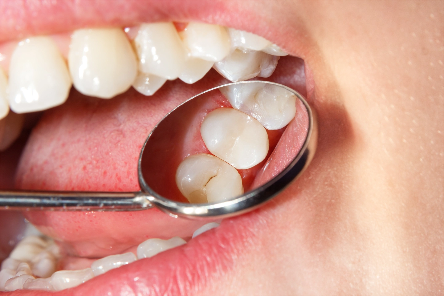 Dental Sealants: A Cost-Effective Solution for Preventing Cavities and Saving Money