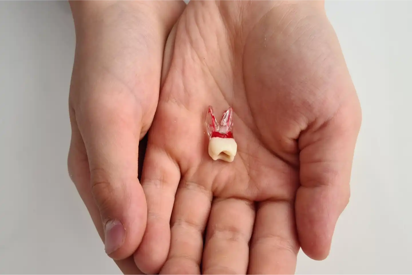 Single Tooth Dental Implants in Manteca, CA