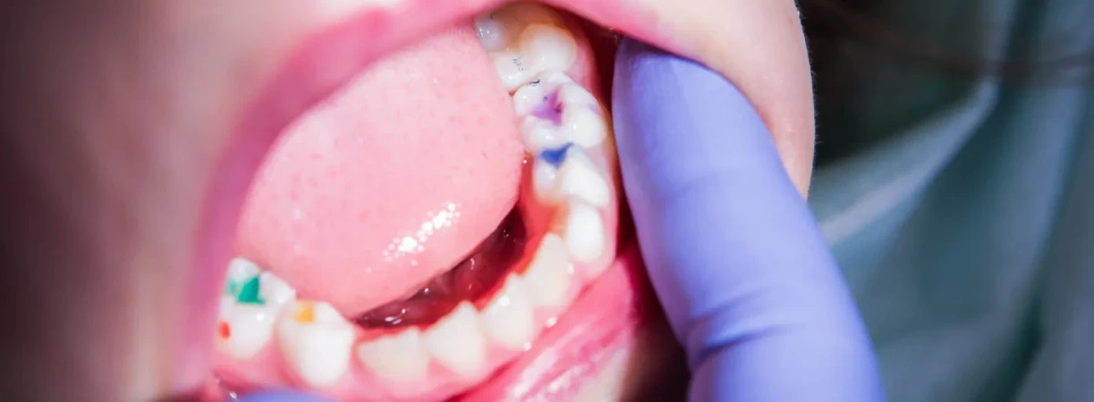 Sealants