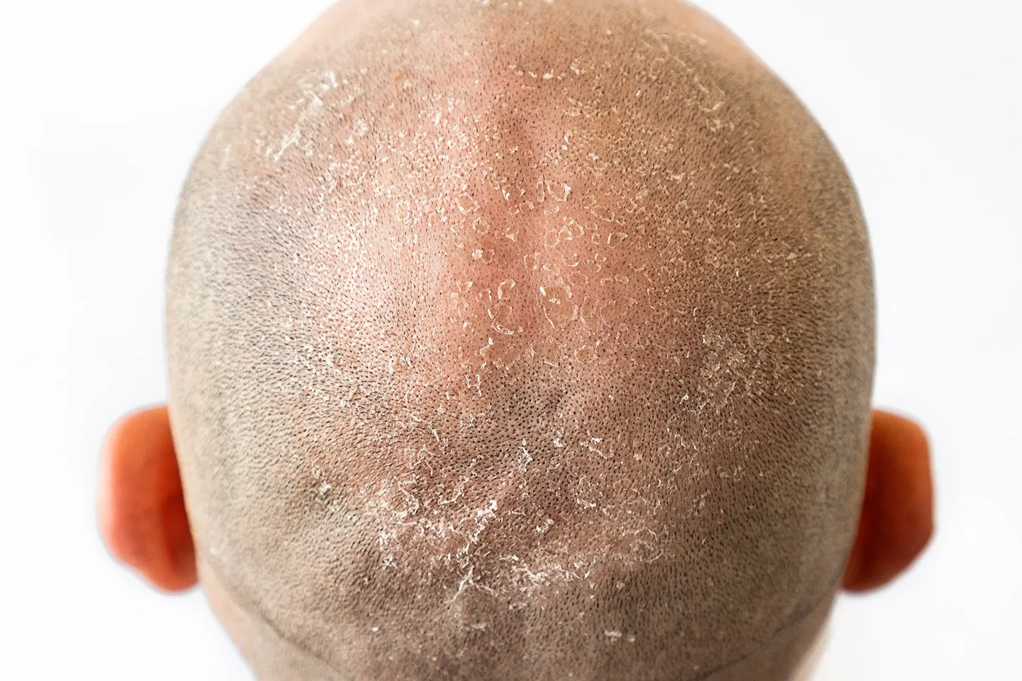 Dandruff on head which cause seborrheic dermatitis