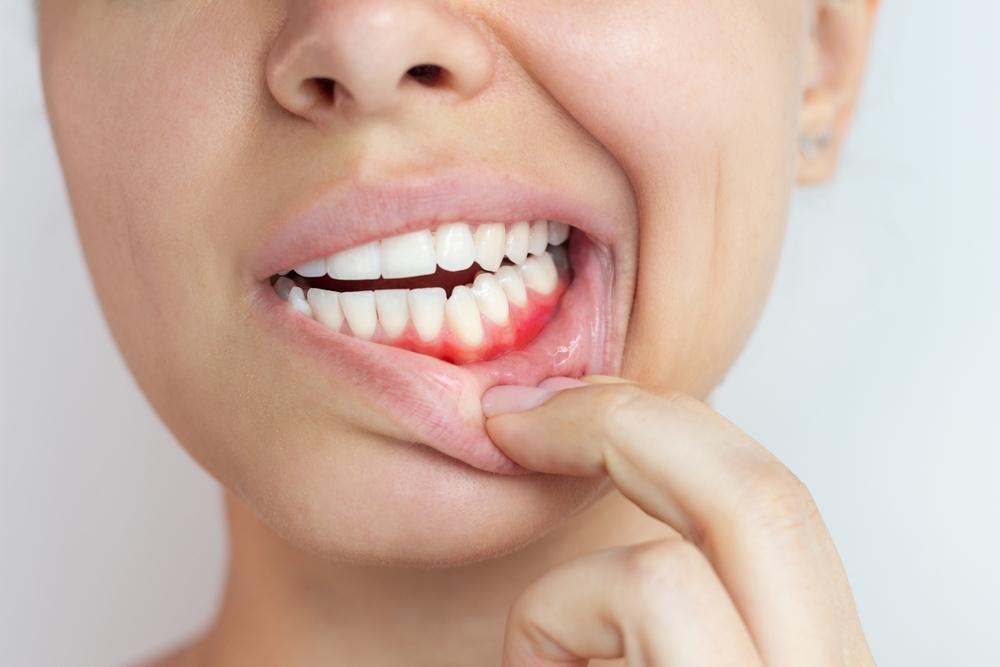 Gum Disease