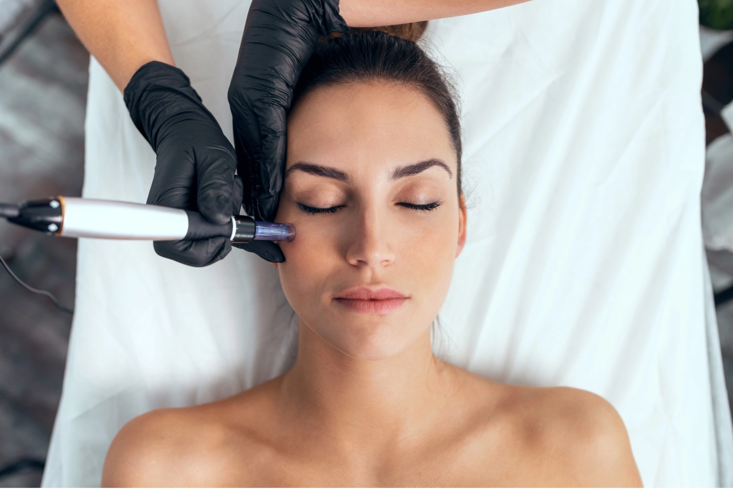 Micro-Needling vs. Laser Therapy 