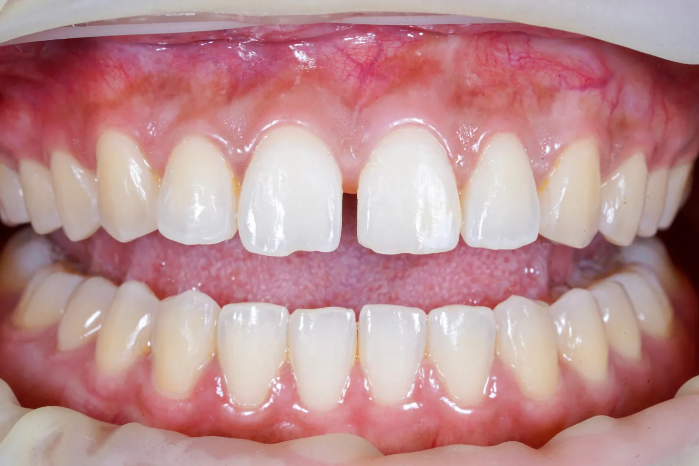 How to Close Tooth Gaps Without Braces
