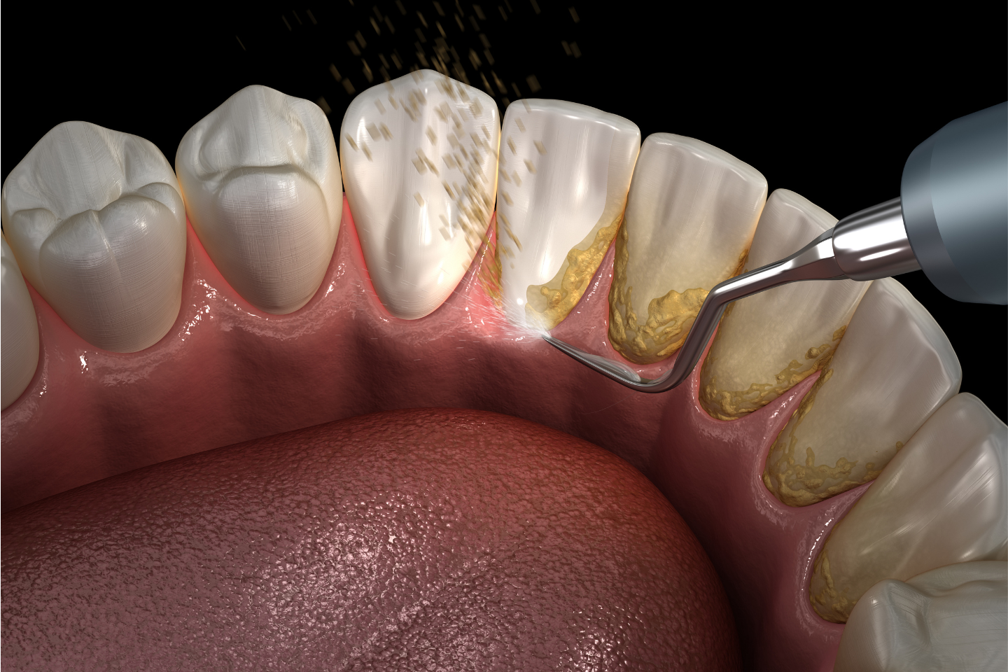 Plaque vs. Tartar