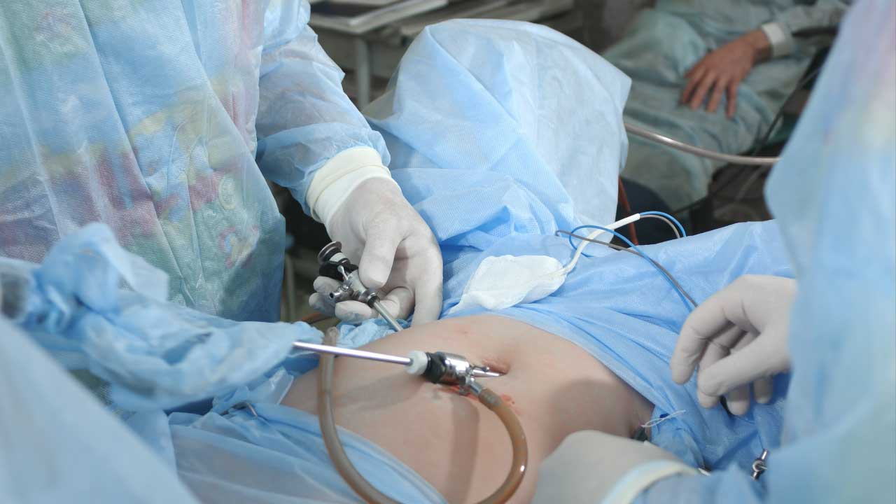 Laparoscopic Surgery Illustration For Ectopic Pregnancy