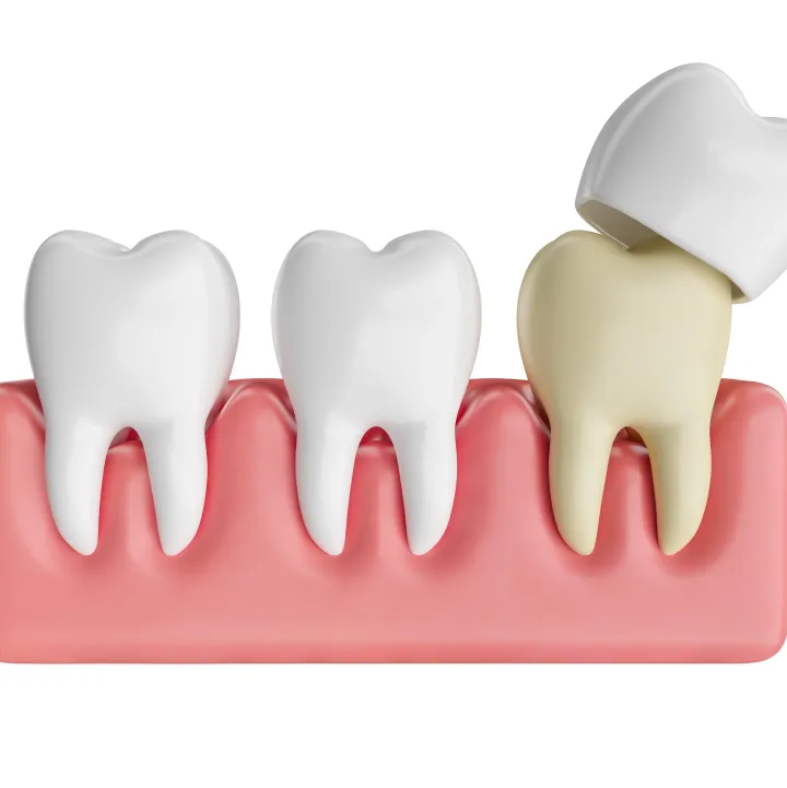 Dental Crowns