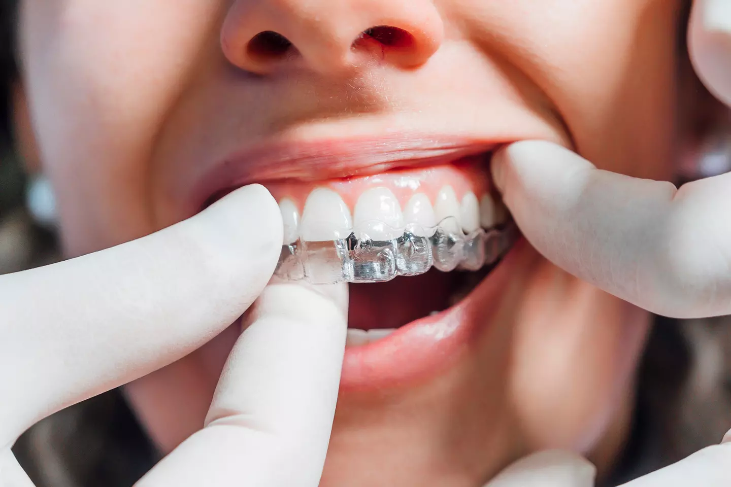 Invisalign clear aligners in Glendale, Queens, NY