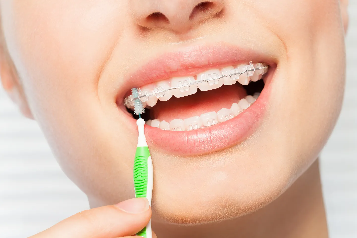 Fighting Plaque in Braces