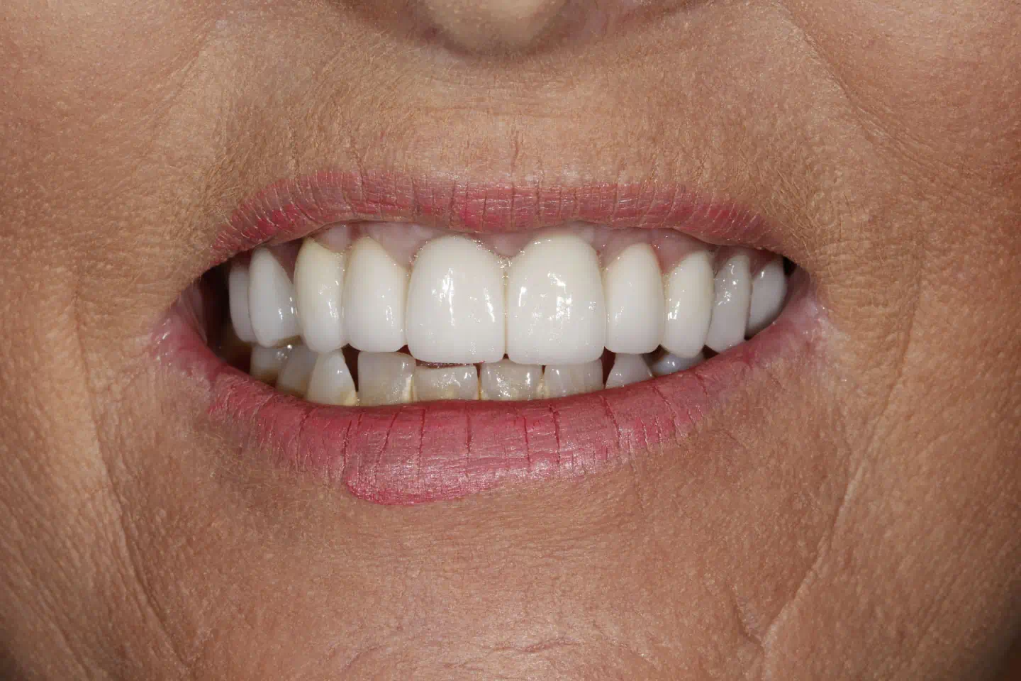 Implant Dentistry