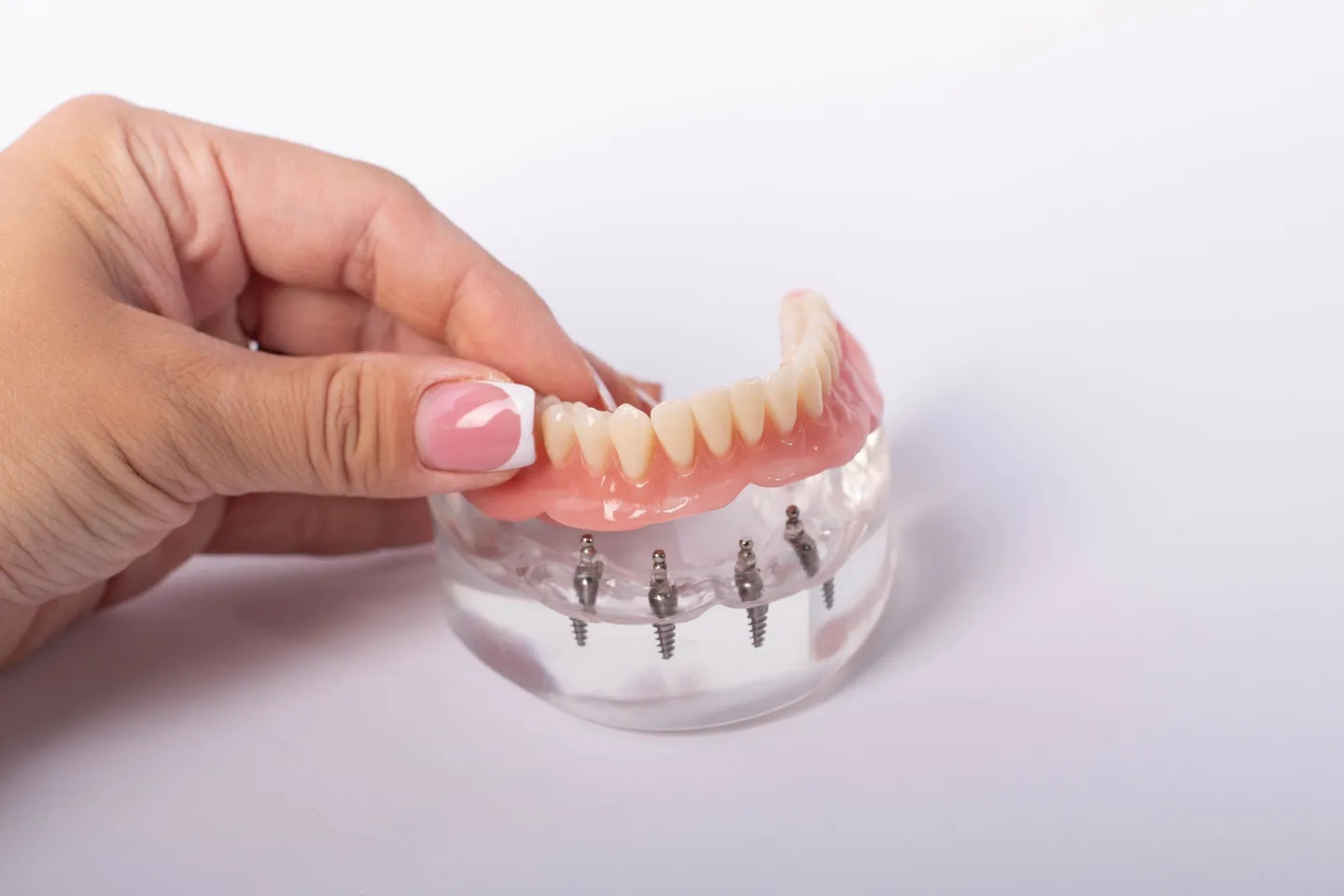 Implant-Supported Dentures at Dental Smile-Savers, the best cosmetic dentist in Bronx
