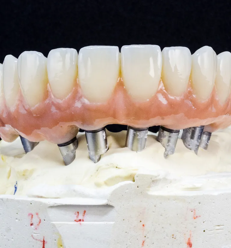 Implant Restorations
