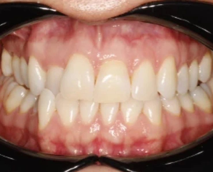 Invisalign Case 2