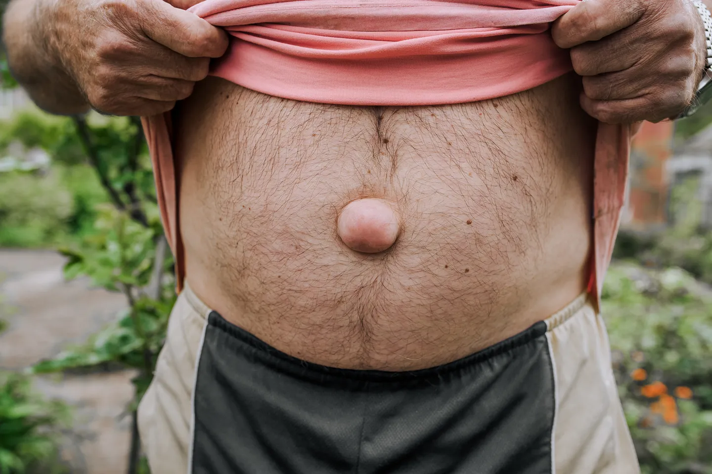 hernia