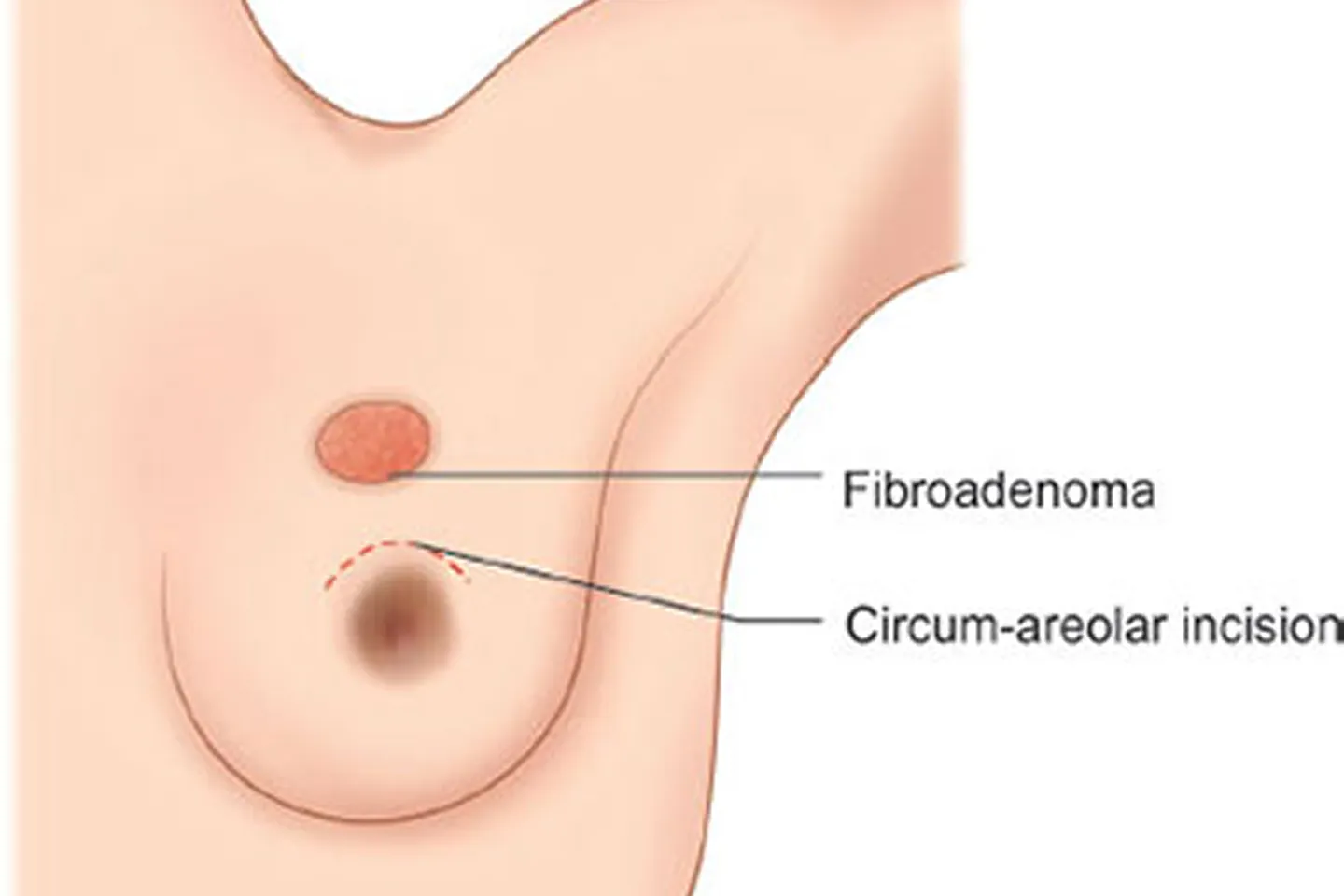 Giant Fibroadenoma Example 1