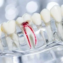 The Top 10 Root Canal Myths Debunked