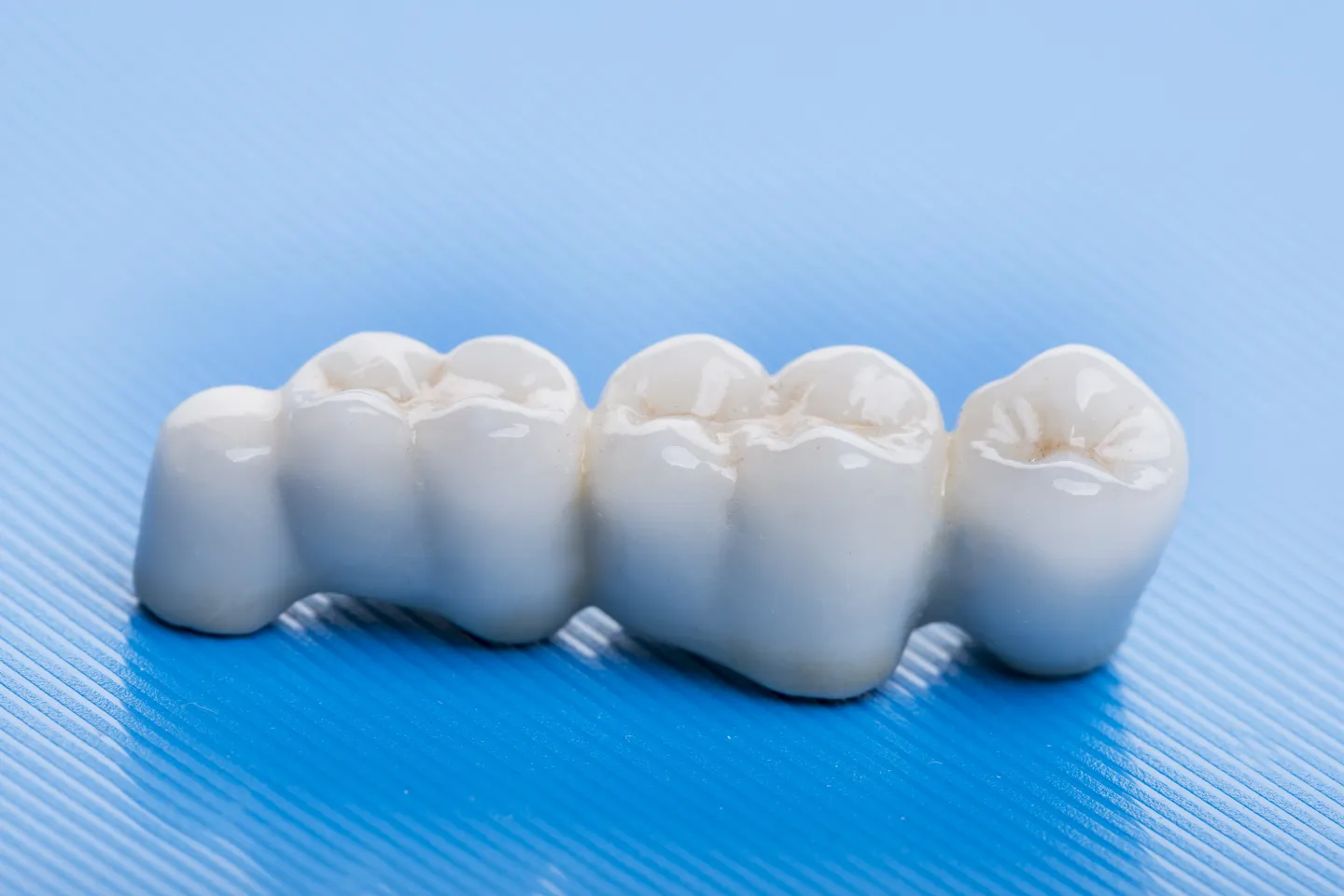 When a Dental Bridge May Be Recommended