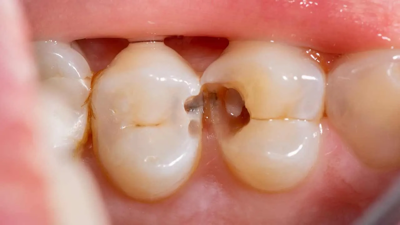 How Do You Know If You Have a Cavity?