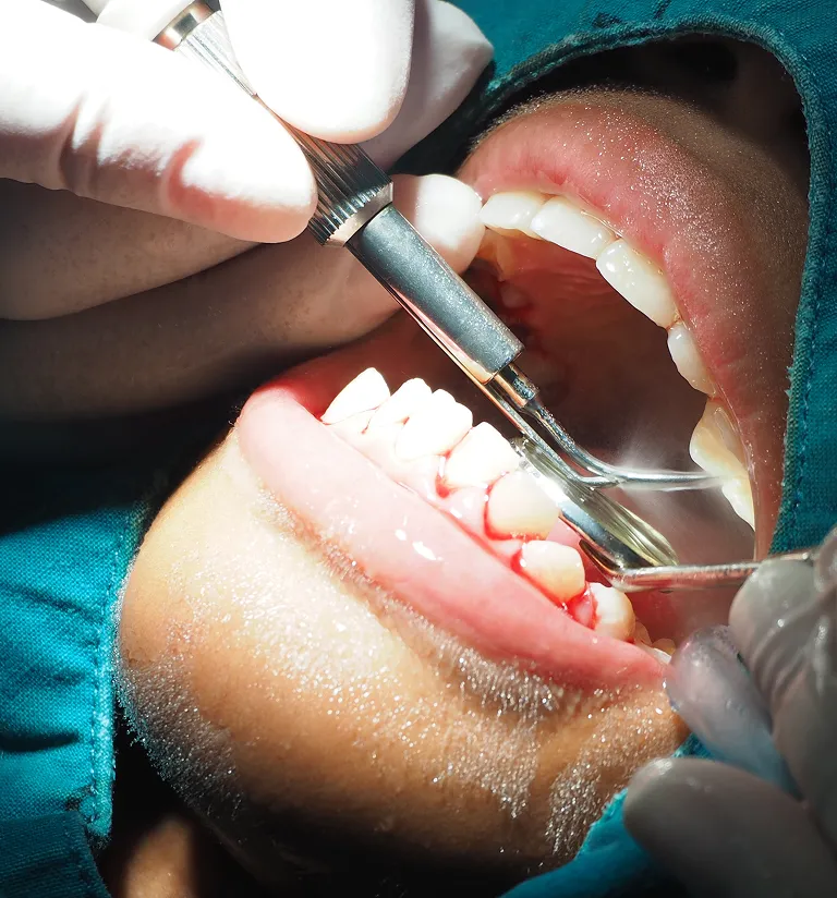 Single Tooth Implant