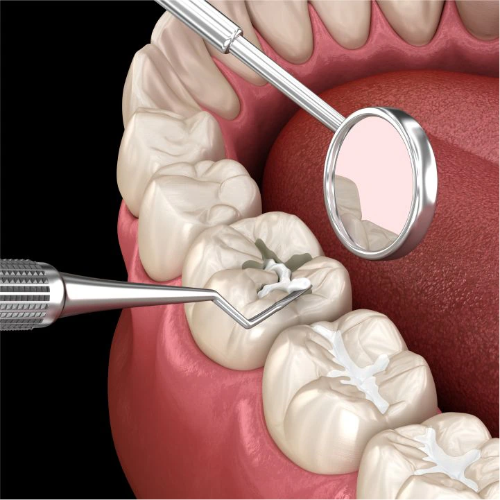 Dental Sealants