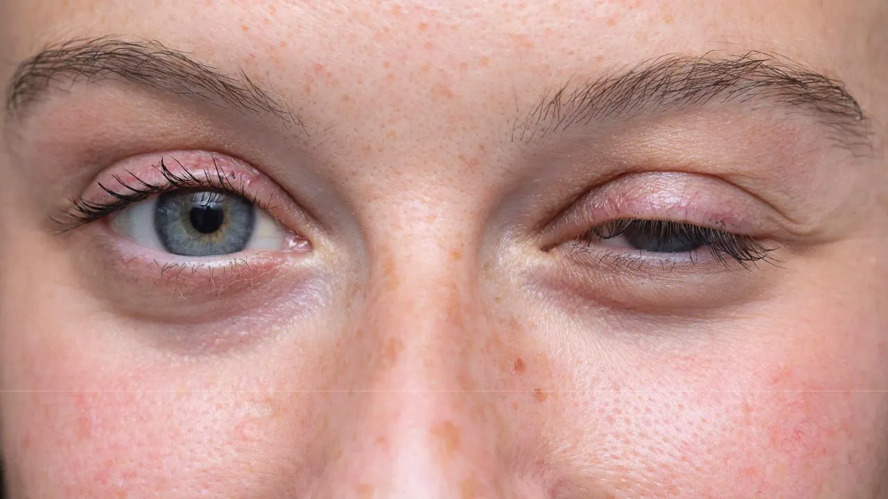 Patient with involuntary eyelid spasms consulting an oculoplastic surgeon