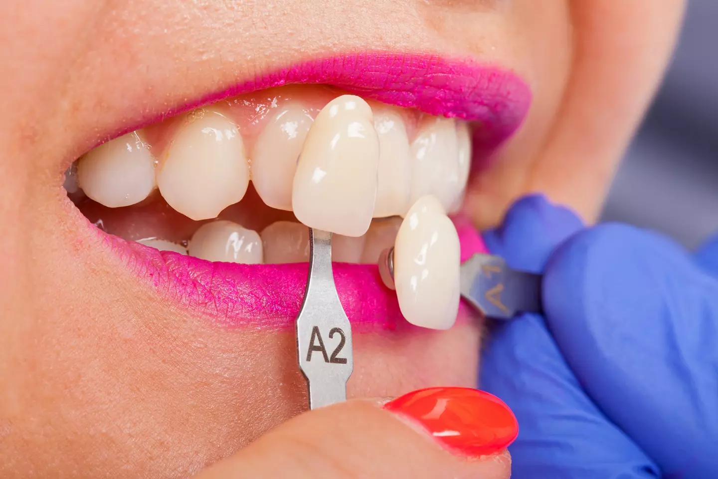 Porcelain Veneers in Palmer, MA