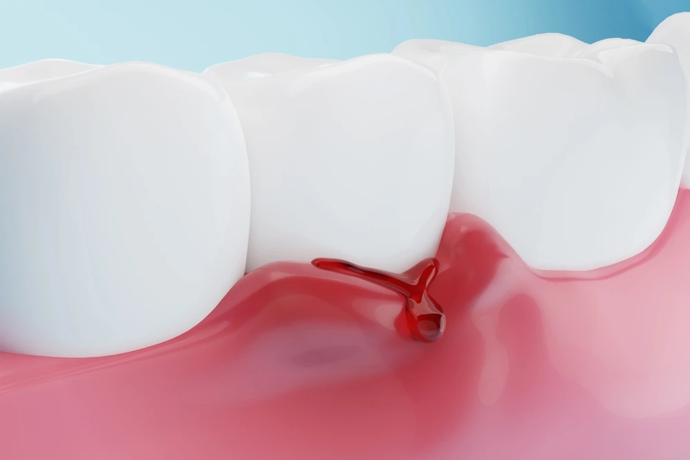 Icon of a toothbrush and bleeding gums indicating gingivitis