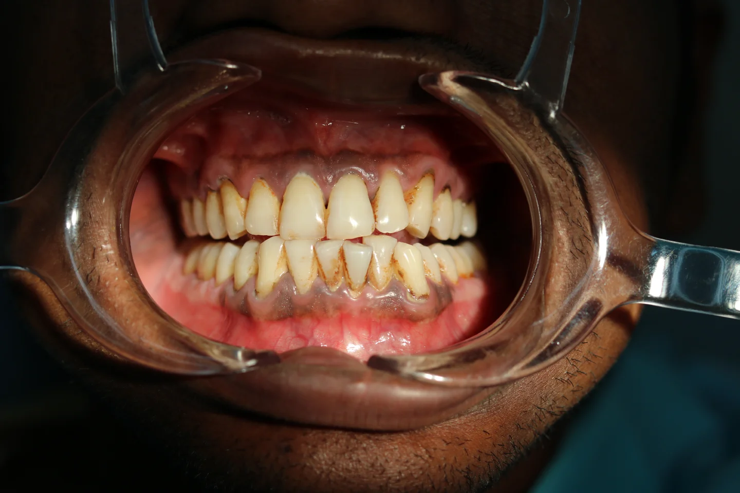 Understanding The Stages Of Gum Disease