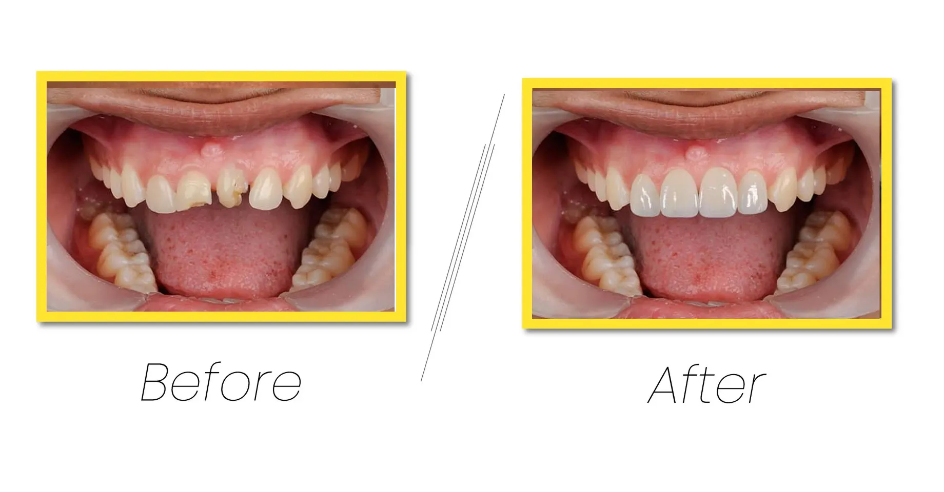Dental Veneers transform smiles with thin porcelain shells