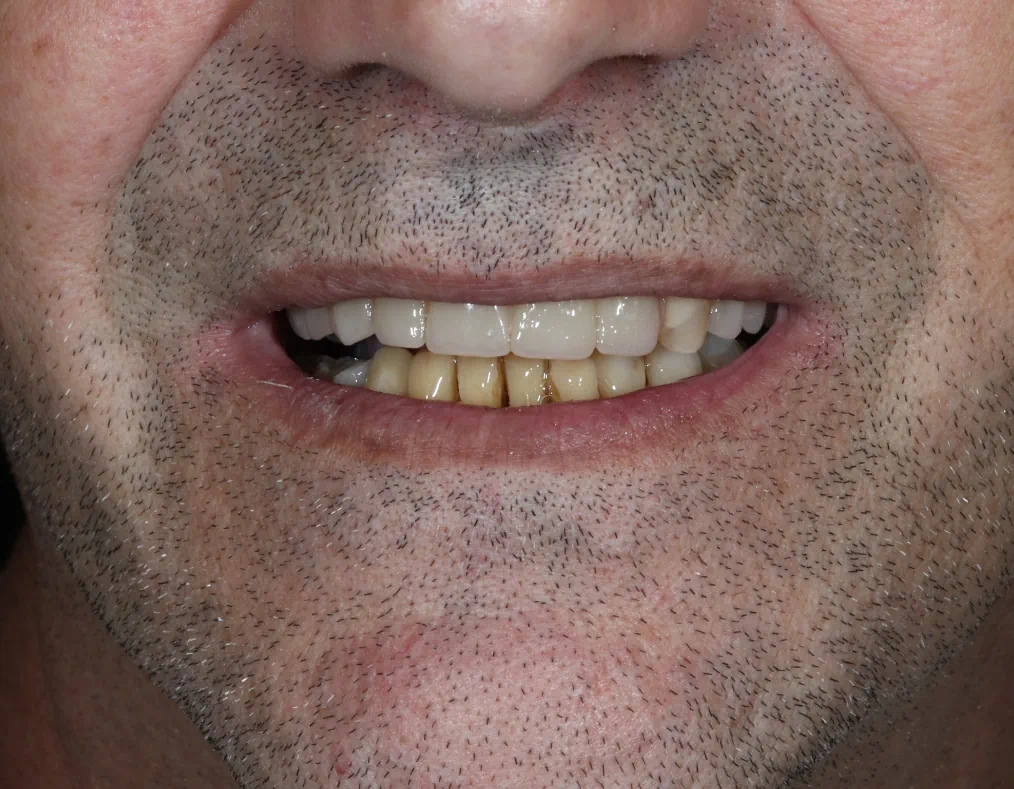 Dentures