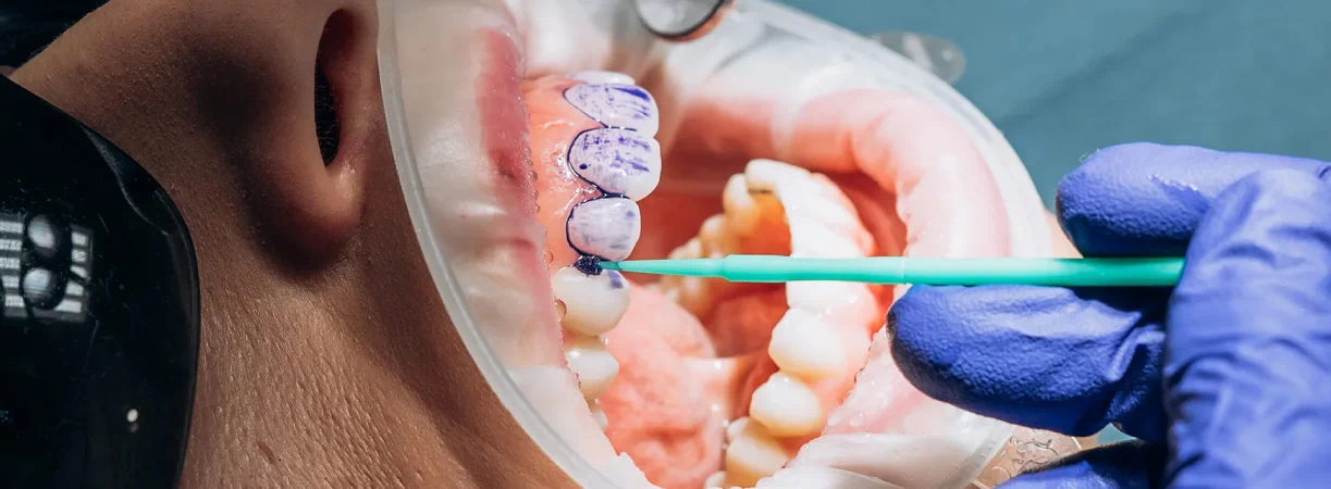 Fluoride Treatment