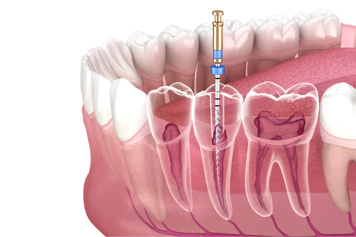 Root canal