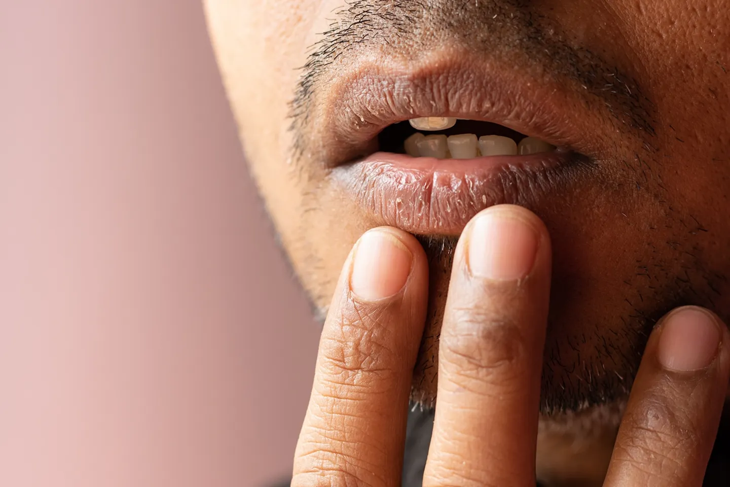 Dry Mouth