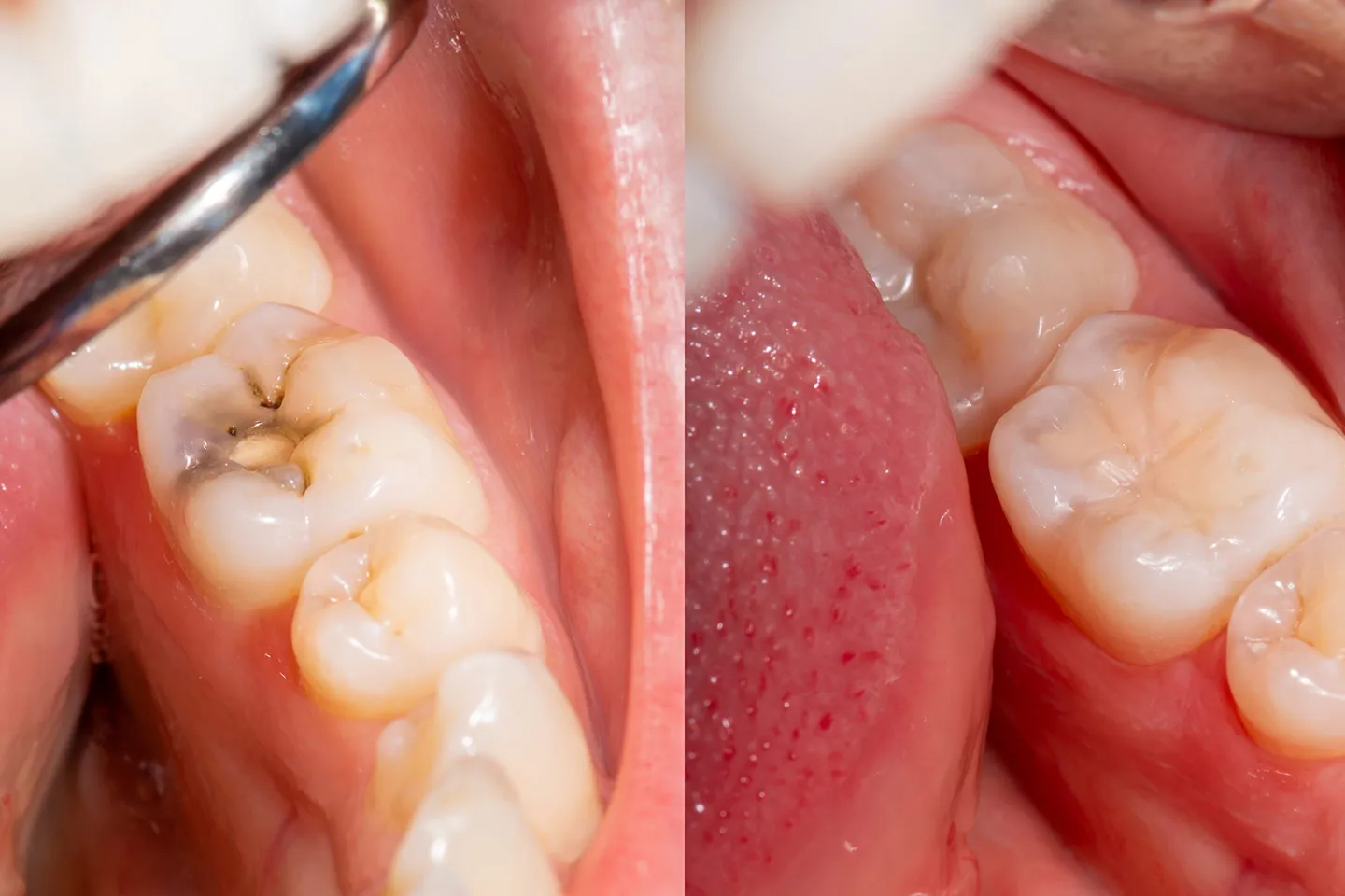 Silver Diamine Fluoride treatments at Spring Field Dental