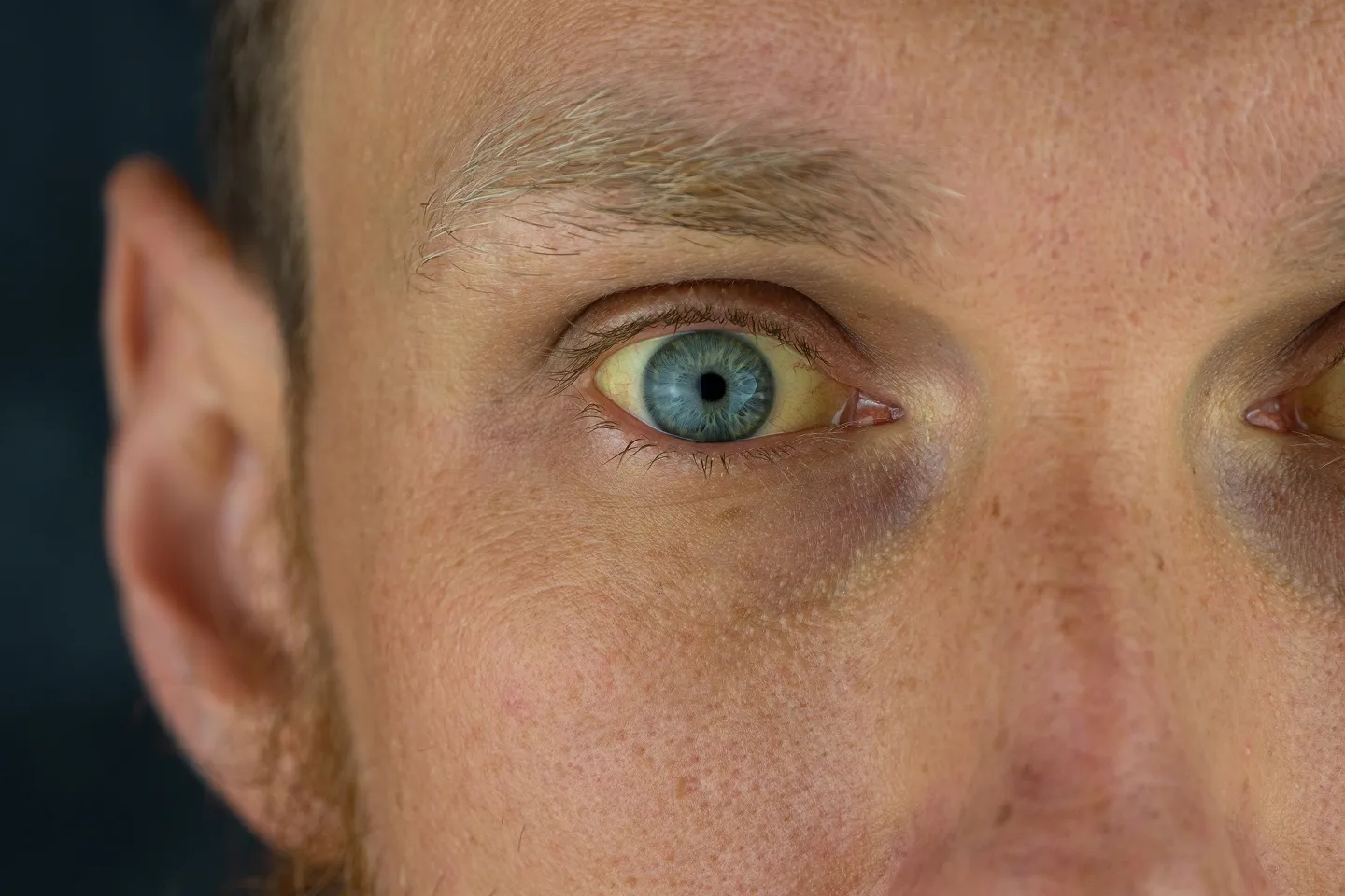 An eye icon with a small tear drop and a highlighted tear duct pathway, showing blockage or flow.