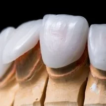 5 Signs You’re a Good Candidate for Veneers