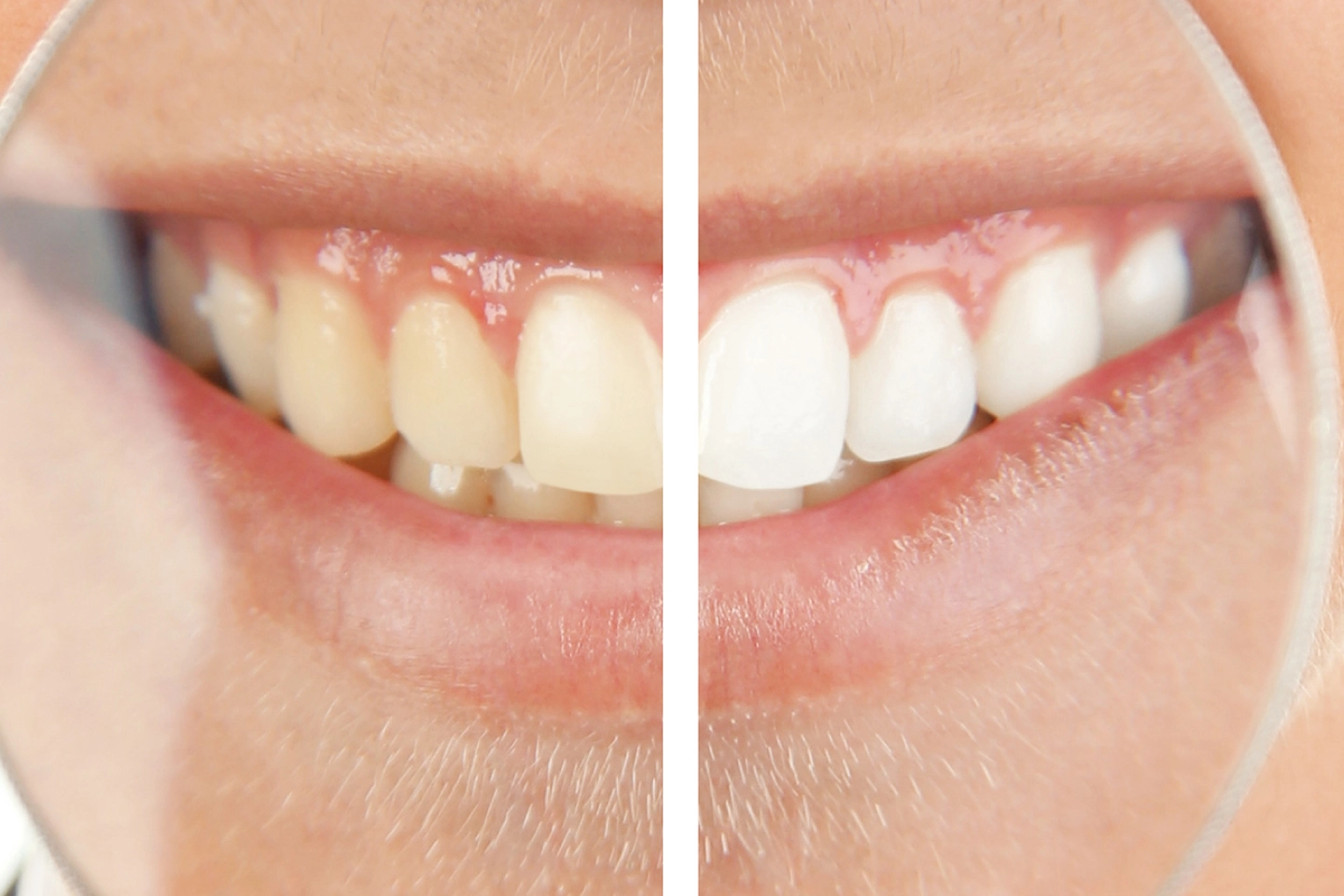 Zoom Teeth Whitening - Rockville Family Dental