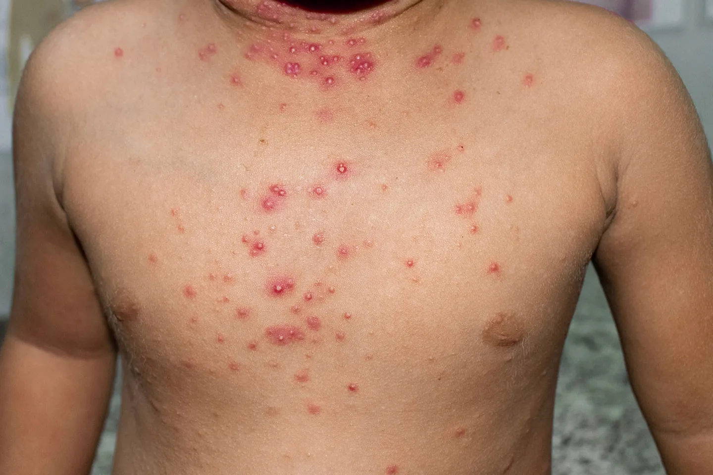 Skin infection caoused by virus in molluscum contagiosum