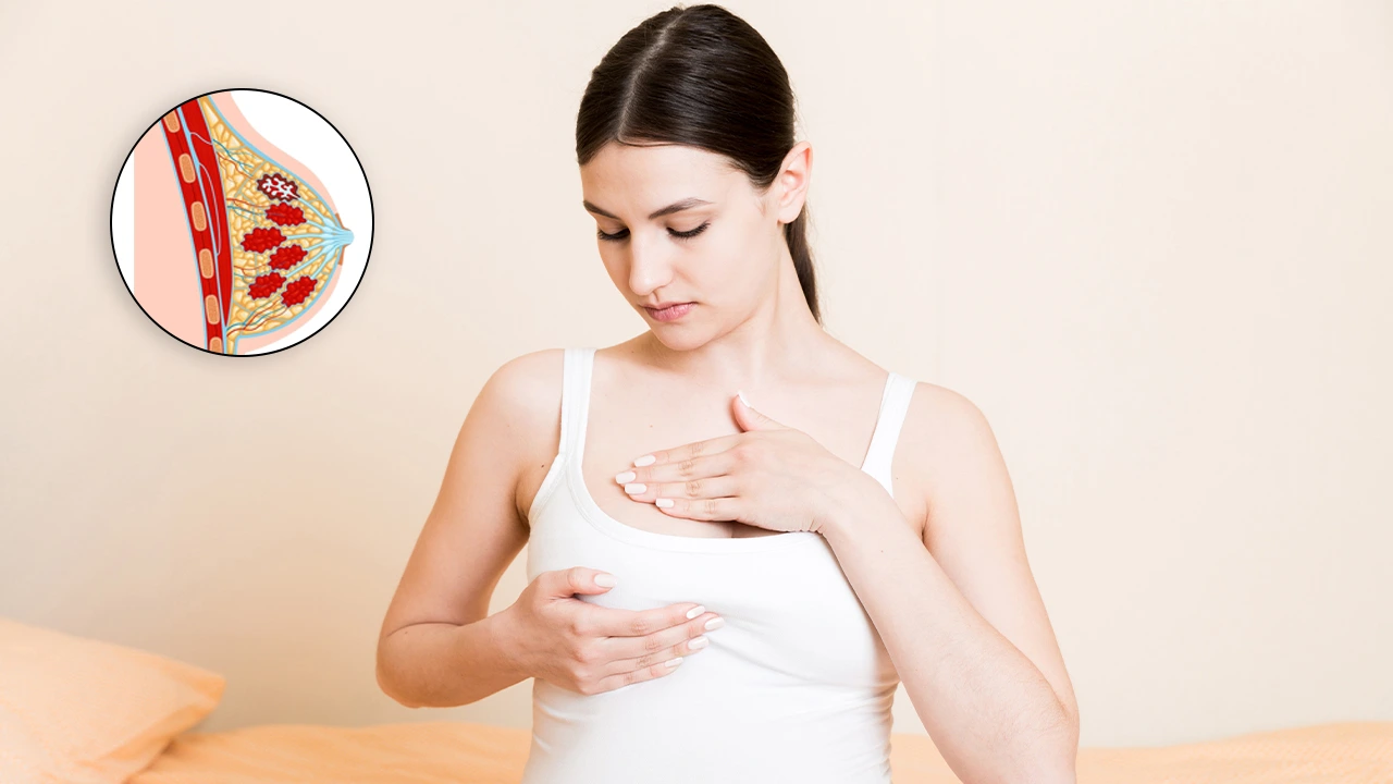 Breast illustration showing inflamed area/abscess.