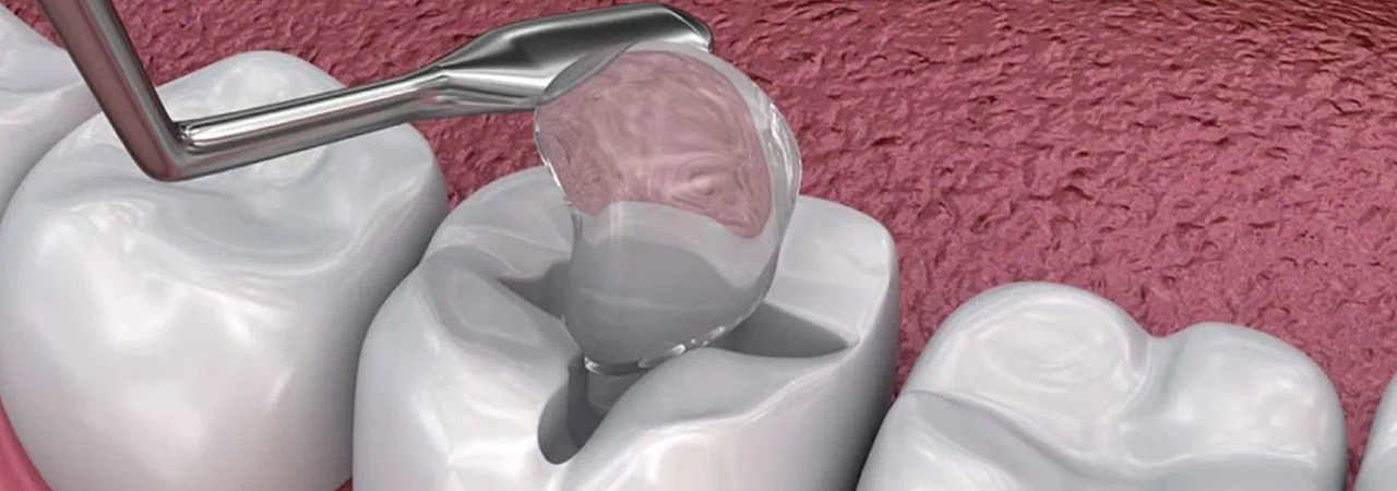 Dental Fillings