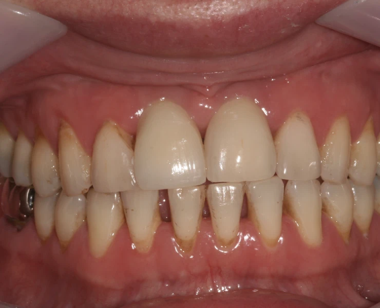 After Dental Implants