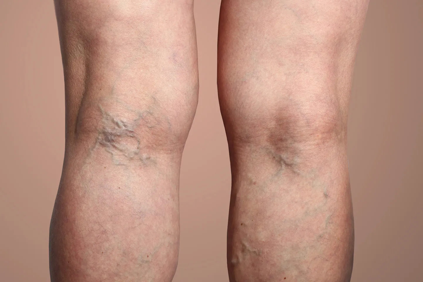 Spider Veins vs Varicose Veins: Know the Key Differences