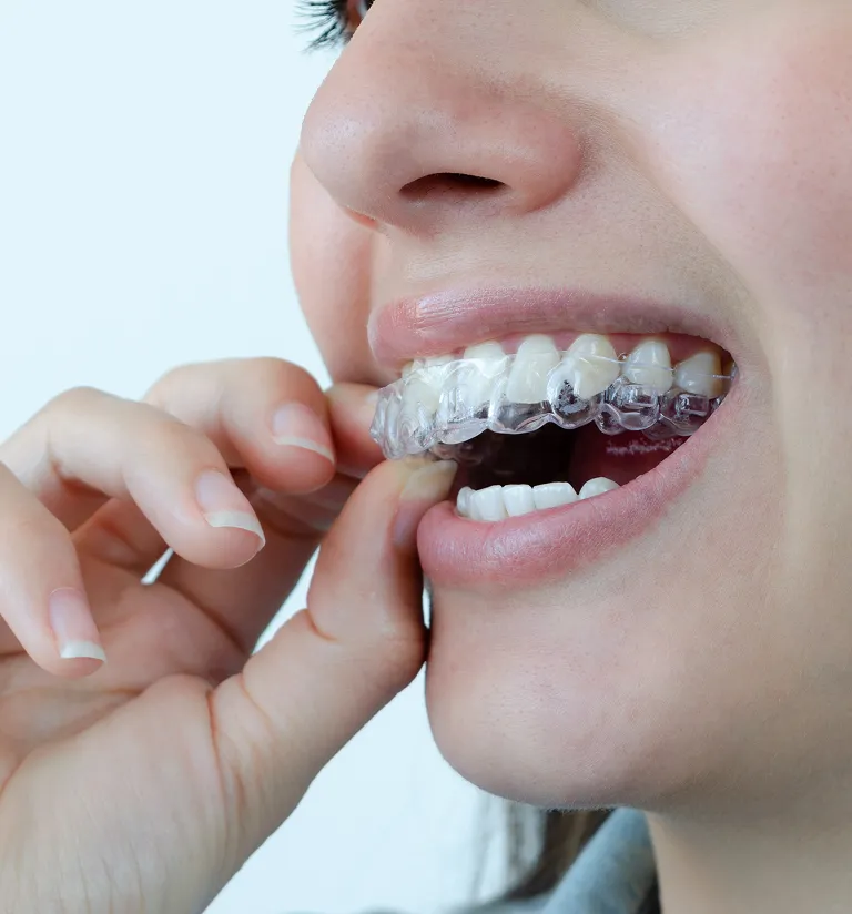 Is It Worth It: The Cost of Invisalign Treatment