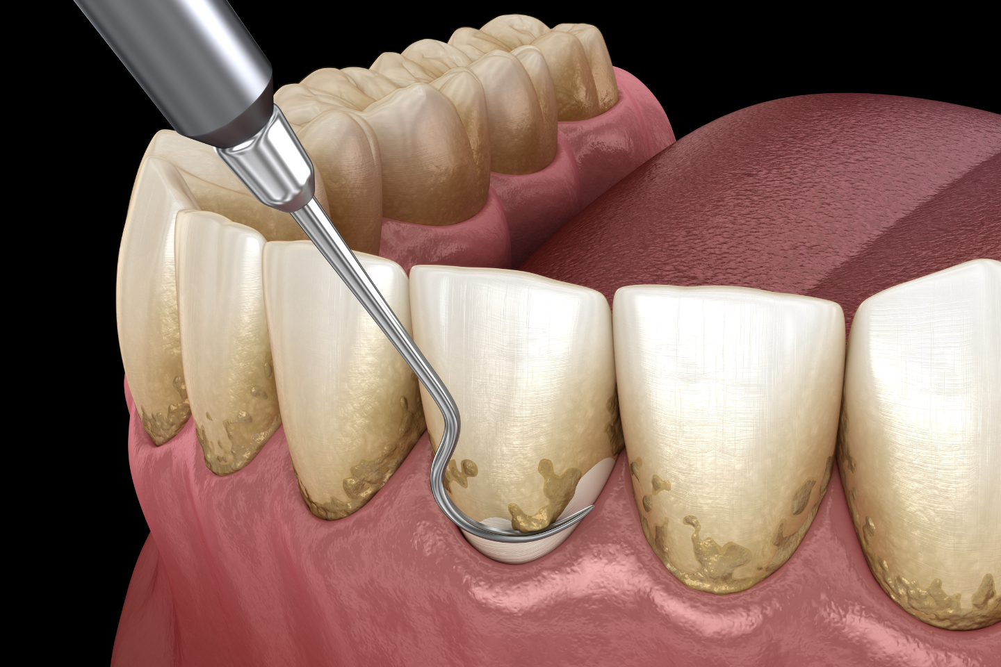 Dental hygienist performing scaling and root planing on patient with inflamed gums.