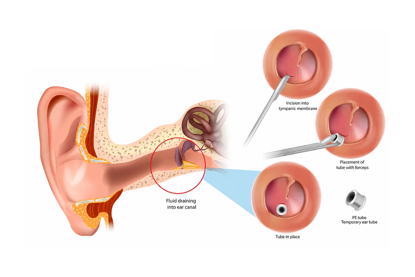 Myringotomy with Grommet Insertion