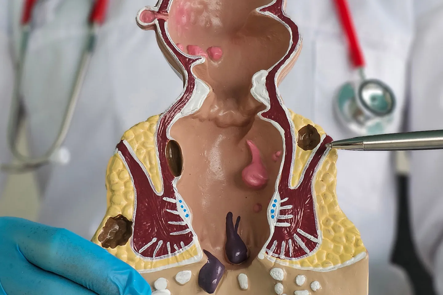 Rectal Prolapse: When Surgery Becomes the Only Solution for Relief