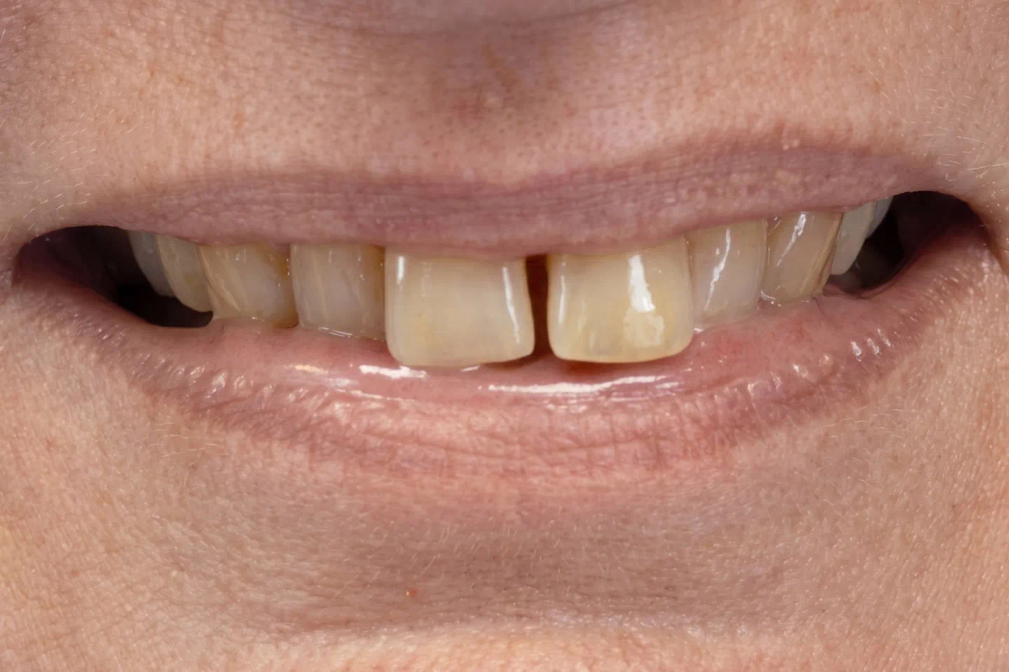 Before Invisalign® treatment showing uneven tooth alignment