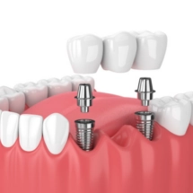 Dental Bridges: Exploring the Different Types and the Superiority of Implanted Bridges